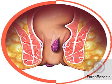 درمان تهران بهترین مرکز برای درمان بیماری مقعدی