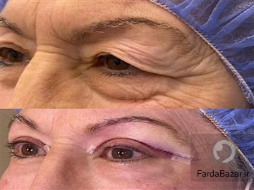 کلینیک بلفاروپلاستی قیطریه تهران